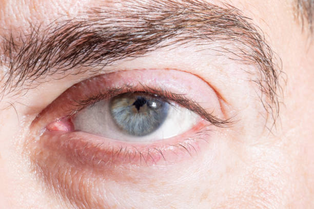 istock Indented and irregular pupil after lens surgery 1487492209
