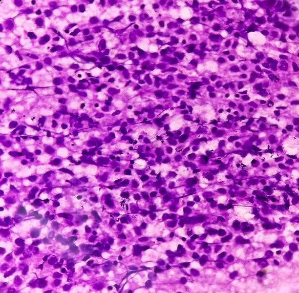 istock Metastatic plasmacytoma, metastatic undifferentiated sarcoma. Plasma cell tumor. 1487509513