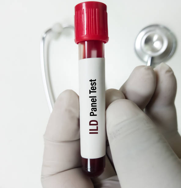 Blood sample for ILD(Interstitial Lung Disease) autoantibody panel test. Blood sample for ILD(Interstitial Lung Disease) autoantibody panel test. to diagnosis of systemic autoimmune rheumatic disease. autoantibody stock pictures, royalty-free photos & images