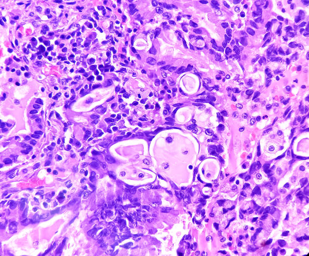 istock Lung cancer - adenocarcinoma, mucinous type. Therapies for specific genetic mutations (biomarkers EGFR, ALK, ROS1, BRAF, PDL1, KRAS) are appropriate for selected cases. 1487512840