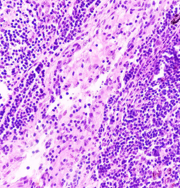istock Lung cancer, reactive change, lymph node show fibro collagenous tissue and neural tissue. 1487513041