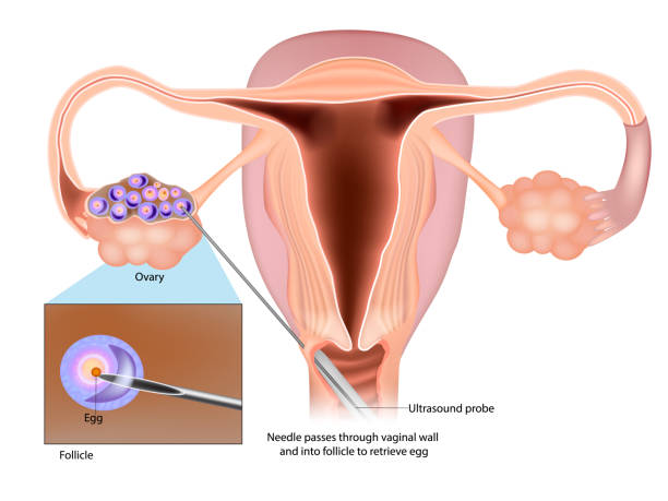 stockillustraties, clipart, cartoons en iconen met ivf egg retrieval technique. egg retrieval procedure before in vitro fertilization. - menselijk ei
