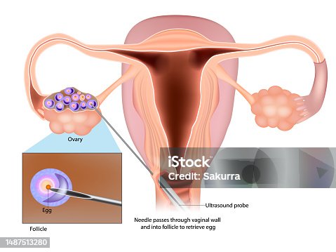 semaglutide and egg retrieval GLP-1s Fertility GLP-1 & Fertility Treatments: What