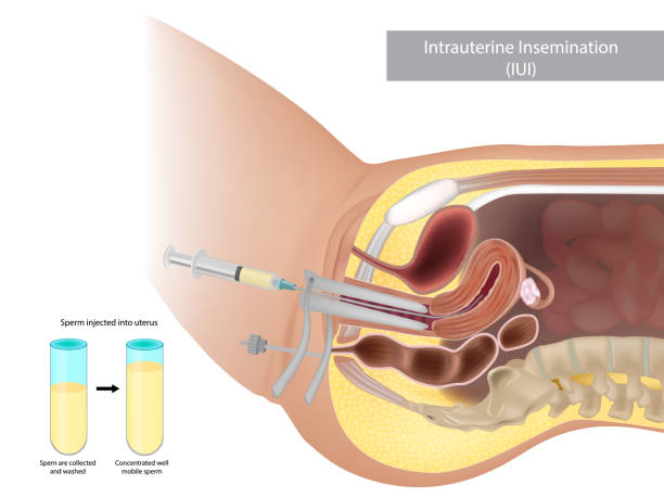 Schematic illustration artificial insemination. Intrauterine insemination IUI. Sperm injected into uterus Schematic illustration of human artificial insemination. Intrauterine insemination IUI. Sperm injected into uterus Ovulation stock illustrations