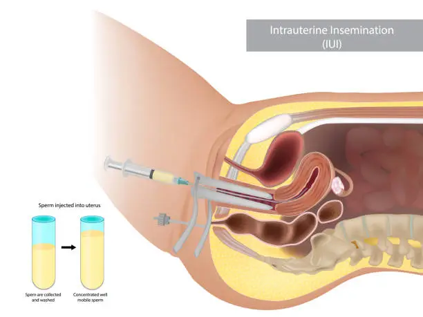 Vector illustration of Schematic illustration artificial insemination. Intrauterine insemination IUI. Sperm injected into uterus