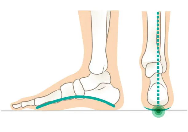 Vector illustration of Lateral and posterior aspect of foot with normal arch