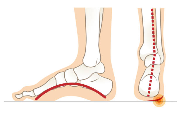 ilustrações de stock, clip art, desenhos animados e ícones de side and back of high arch foot - human foot pain white background isolated