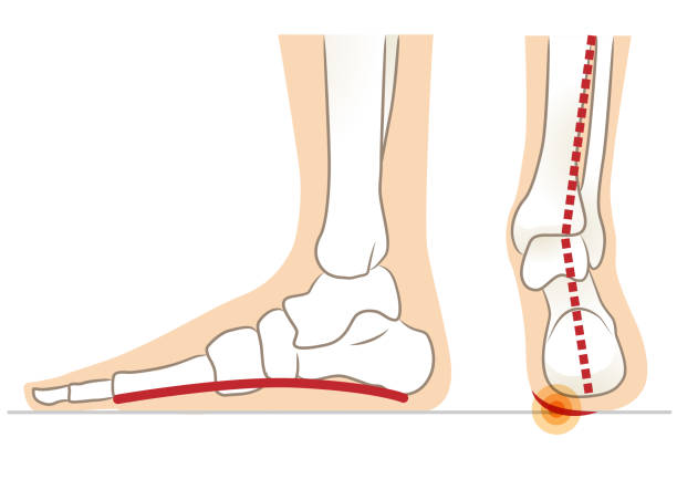 Lateral and posterior aspects of flat feet Lateral and posterior aspects of flat feet pes planus stock illustrations