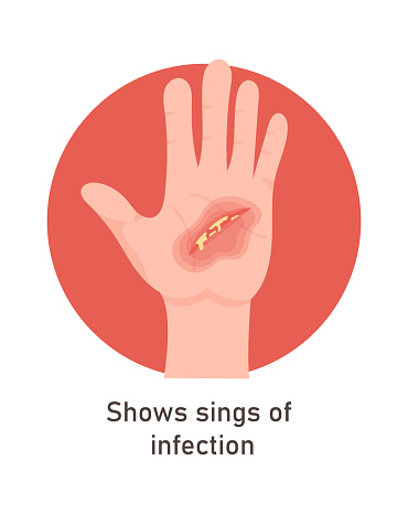 Signs Of Infection On Hand Wound Vector Illustration