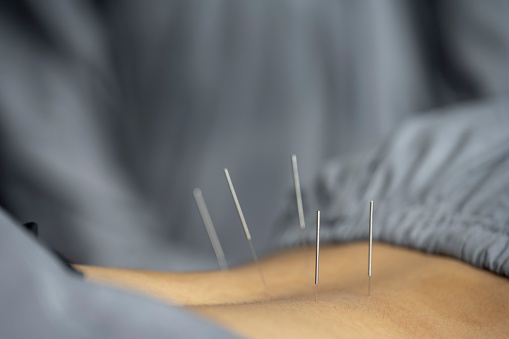 Traditional Chinese medical acupuncture