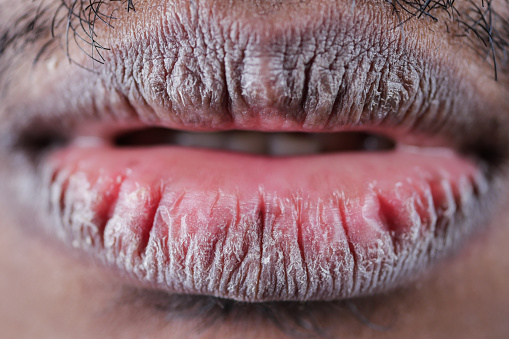 Close up of dry lip of a young men ,