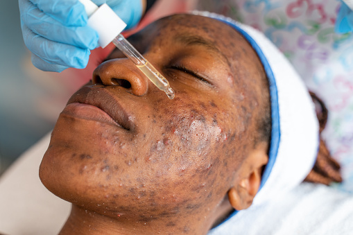 Antibiotic facial mask applied to a black woman in a wellness spa center