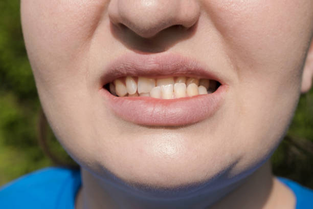 顎の脱臼と不正咬合、顎関節機能障害のある患者女性。彼女は口を開けていて、この機能不全を示しています。 - sticking out tongue ストックフォトと画像