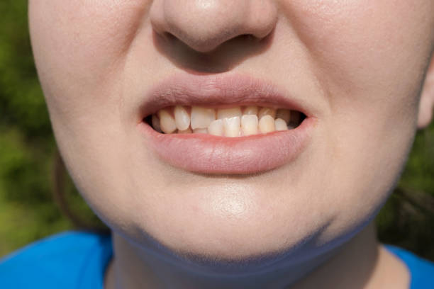 istock Patient woman with dislocated jaw and malocclusion, temporomandibular joint dysfunction. She is opening her mouth and shows this disfunction. 1487900656
