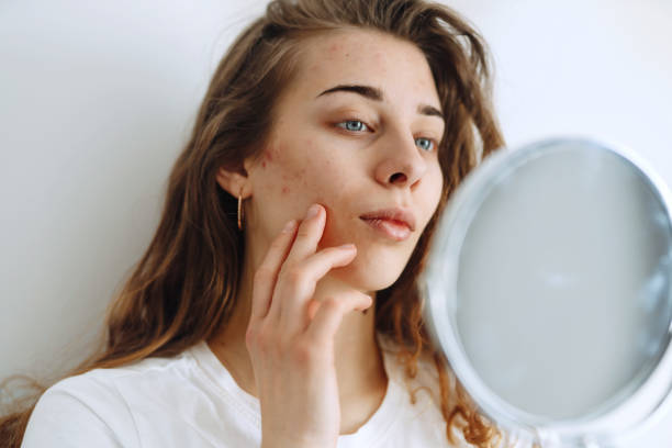 istock Young woman  with problem skin looking into mirror. 1487914200