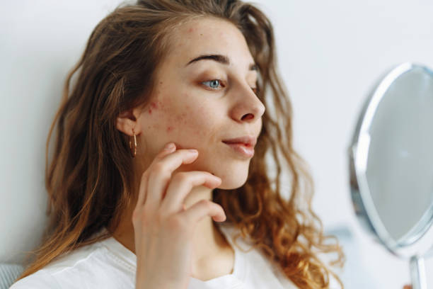 istock Young woman  with problem skin looking into mirror. 1487914208