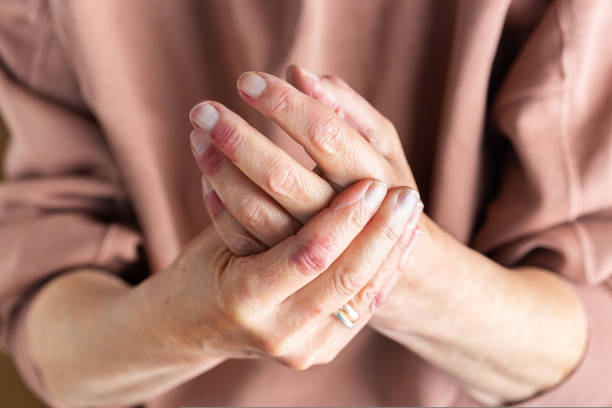 Woman hands with atopic dermatitis, eczema, allergy reaction on skin Close up of elder woman hands with atopic dermatitis, eczema, allergy reaction on dry skin photo psoriasis stock pictures, royalty-free photos & images