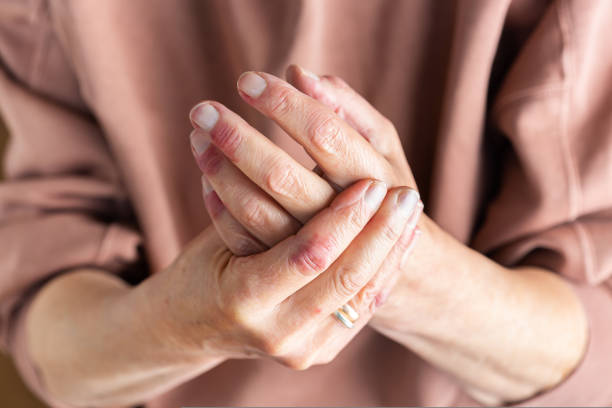 женские руки с атопическим дерматитом, экземой, аллер�гической реакцией на коже - dermatitis dry human hand human skin стоковые фото и изображения
