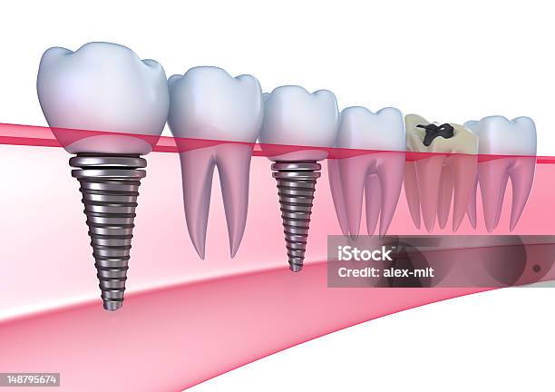 Стоматологическая Импланты В Гумизолированные На Белом — стоковые фотографии и другие картинки Белый