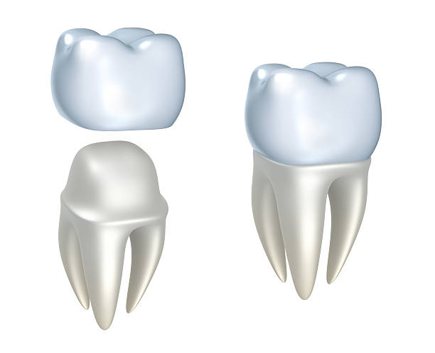 Sequential images of dental crowns and tooth Dental crowns and tooth, isolated on white  dental crown stock pictures, royalty-free photos & images