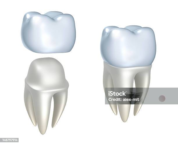 Sequential Images Of Dental Crowns And Tooth Stock Photo - Download Image Now - Tooth Crown, Ceramics, Temporary