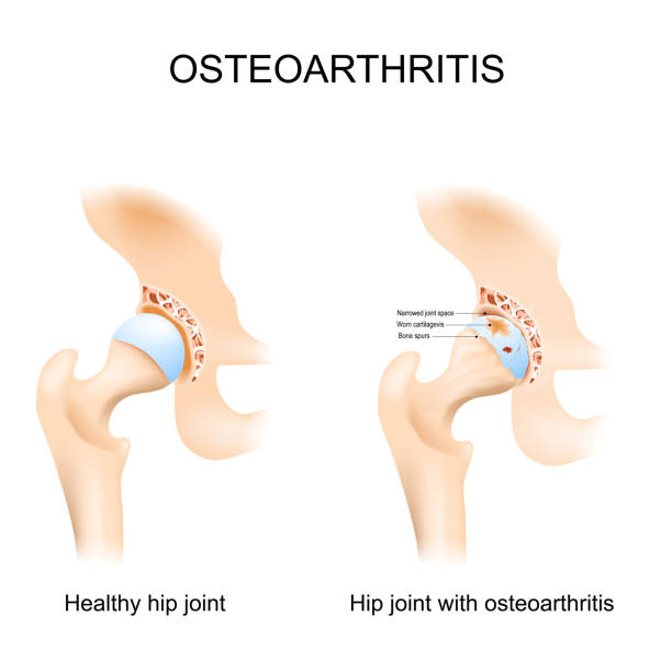 ilustrações de stock, clip art, desenhos animados e ícones de hip joint with osteoarthritis - osteoartrite