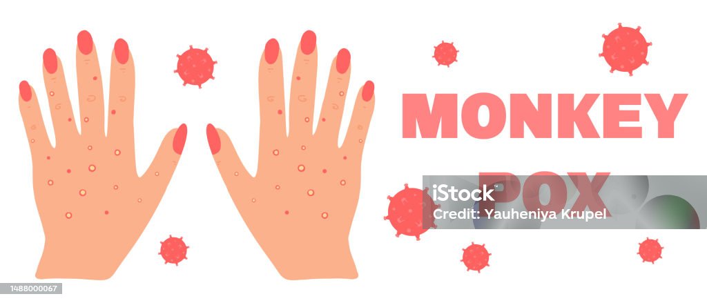 Smallpox Hand Image Banner With Smallpox Monkey Monkeypox Hands With A Rash Smallpox ...
