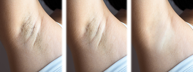 Asian woman showing her underarms Three levels of armpit hair removal and after underarm chicken skin removal
