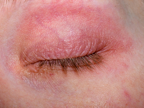 Dry skin of the eyelids, reddened, itchy, atopic blepharitis.  Closed eye with contact allergy close up