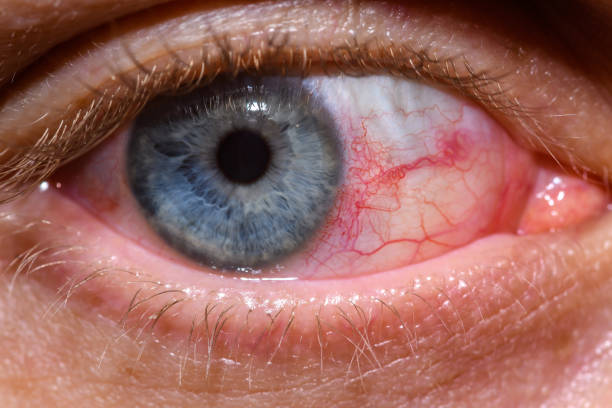 istock red bloodshot eye, conjunctivitis, allergy 1488090292
