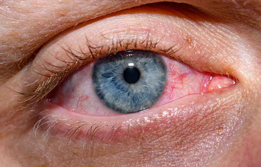 Red eye, pink protein, allergy, conjunctivitis.  Open eye with blue iris as painted