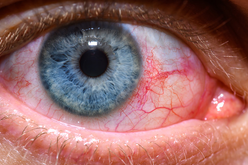 Open eye with blue iris.  eye redness, allergy, conjunctivitis, dry eye syndrome