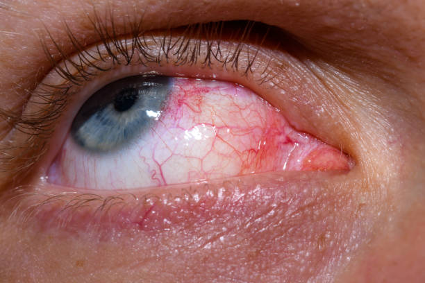 istock open human eye, red veins, irritation, allergic sensitization 1488091934