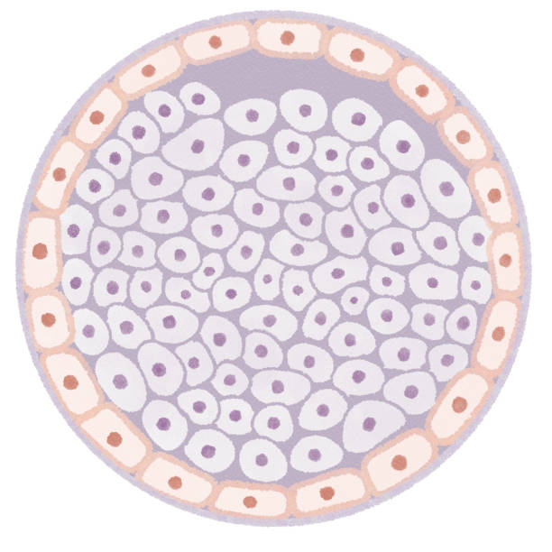 ductal carcinoma in situ (dcis) 유방암 다이어그램 - lactiferous duct stock illustrations