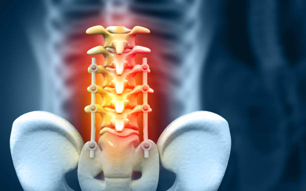 istock spinal column with implant, screw placement, 3d illustration 1488353378