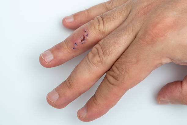 istock Stitched wound on a finger. Hand with stitched cut wound 1488539794