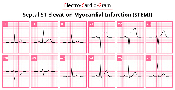 Septal STEMI (ST-Elevation Myocardial Infarction) - The Differences in ECG Waveform for Each of the 12 Leads - Vectors and Illustrations for Medical Purposes