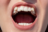 Curved female teeth, before installing braces Close - up