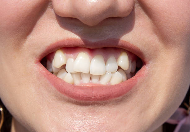 Curved female teeth, before installing braces. Close - up of teeth before treatment by an orthodontist