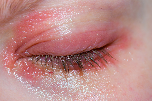 Eczema on the eyelids, red and swollen skin around the eyes