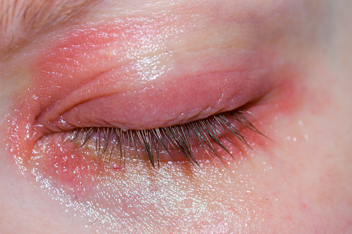 Inflammation Of The Eyelids Reddened Skin Allergy Swelling Rash Stock inflammation-of-the-eyelids-reddened-skin-allergy-swelling-rash-stock