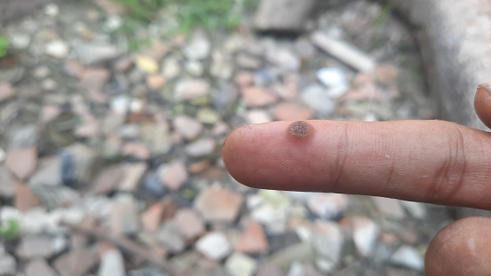 a wart that grows on the index thumb finger