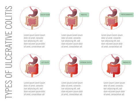 Infographic: types of ulcerative colitis according to the affected area