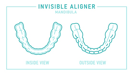 Orthodontic silicone trainer. Invisible braces aligner, retainer. Medical scheme. Inside and outside view. Under jaw. Horizontal poster. Editable vector illustration isolated on a white background.