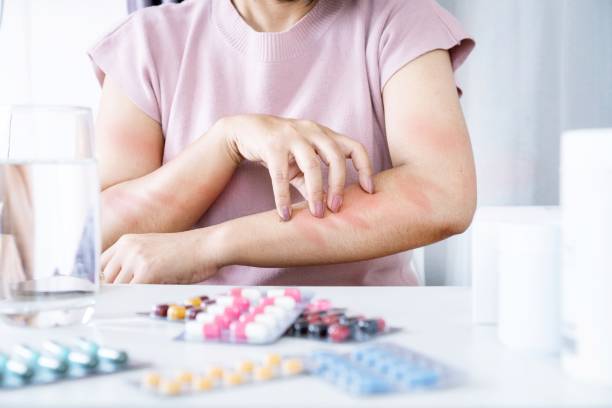 Woman's Allergic Reaction to Medication: Scratching Itchy Skin on Arm from Side Effects stock photo