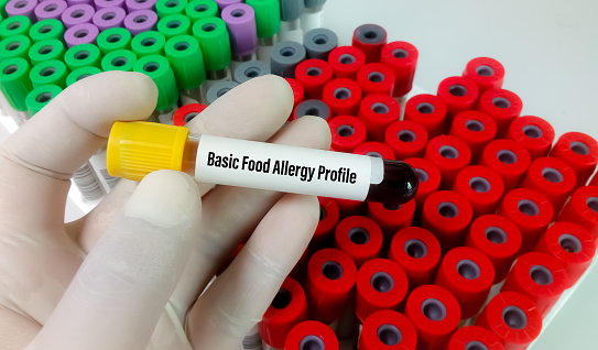 Blood Sample For Basic Allergy Profile Test Stock Photo Download blood-sample-for-basic-allergy-profile-test-stock-photo-download