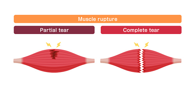 Body Rupture Muscle Rupture Vector Illustration Stock Illustration - Download Image ...