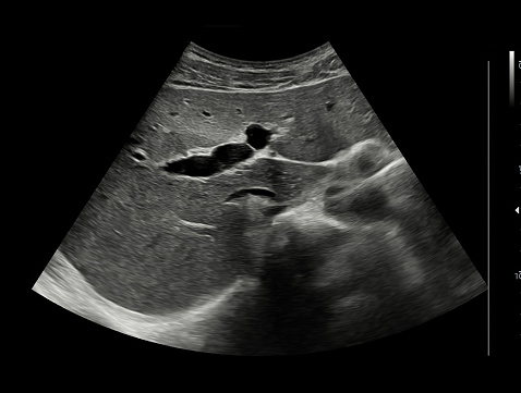 An ultra sound of a baby. 