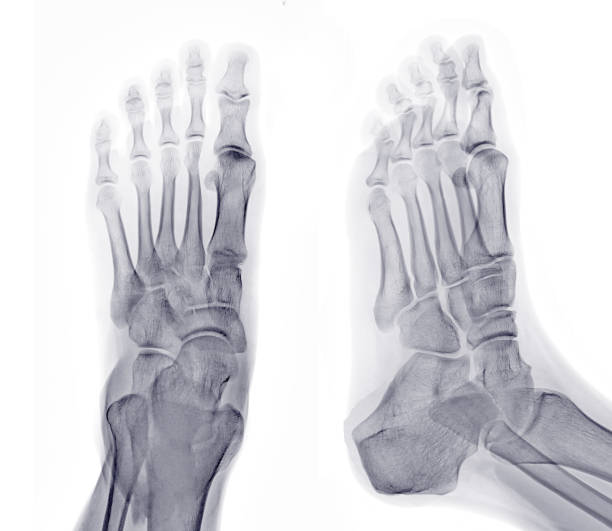 istock Foot x-ray image AP and Oblique  view  isolated on white background. 1489103782