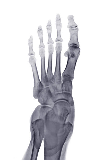 istock Foot x-ray image AP iew  isolated on White  background. 1489103788